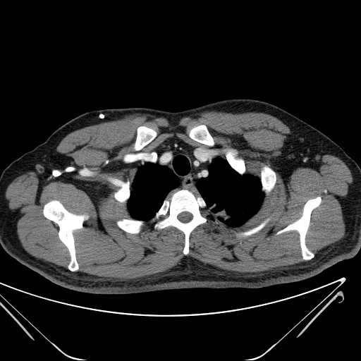 File:Cannonball pulmonary metastases (Radiopaedia 67684-77101 D 34).jpg