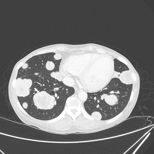 File:Canonball lung metastasis (Radiopaedia 77634-89837 Axial lung window 131).jpg