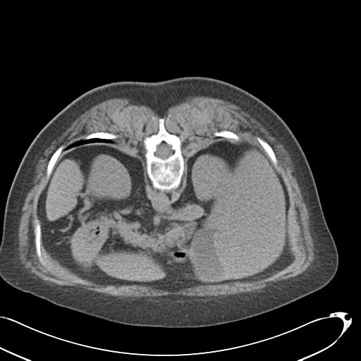 File:Carcinoid tumor - lung (Radiopaedia 44814-48644 Axial non-contrast 32).png