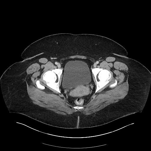 Carcinoid tumor - terminal ileum (Radiopaedia 60931-68739 A 128).jpg