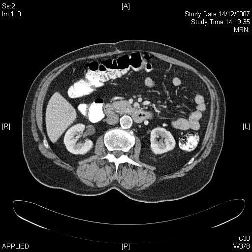File:Carcinoid tumor of jejunum (Radiopaedia 15291).jpg