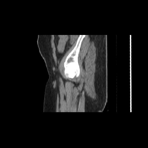 File:Carcinoma cervix- brachytherapy applicator (Radiopaedia 33135-34173 D 4).jpg