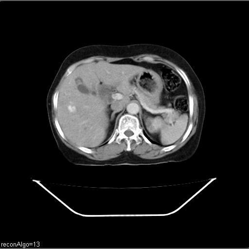 Carcinoma cervix- recurrence (Radiopaedia 34702-36137 B 13).jpg