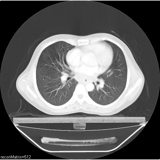 File:Carcinoma of esophagus (Radiopaedia 27356-27550 Axial lung window 17).jpg