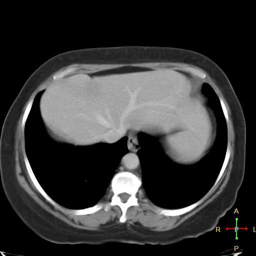 File:Carcinoma of sigmoid colon (Radiopaedia 23071-23100 B 1).jpg