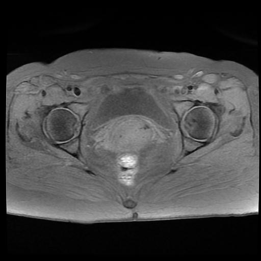 File:Carcinoma of the cervix (Radiopaedia 89018-105858 Axial T1 fat sat 12).jpg