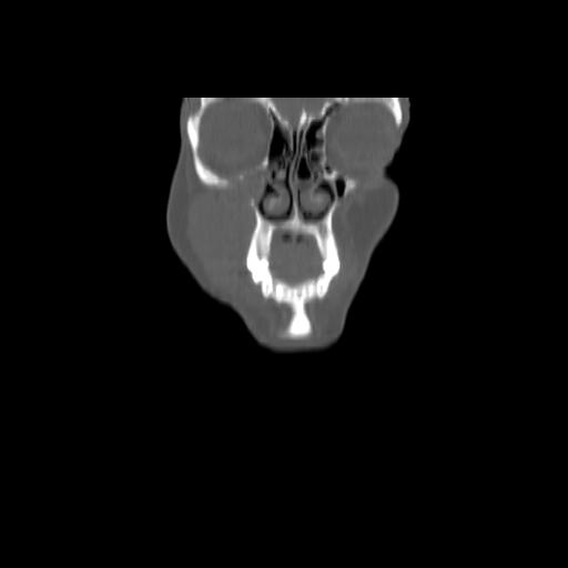 Carcinoma of the maxillary antrum (Radiopaedia 53805-59888 Coronal bone window 24).jpg