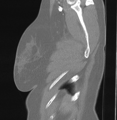 Cardiac sarcoidosis (Radiopaedia 74548-85534 Sagittal lung window 3).jpg