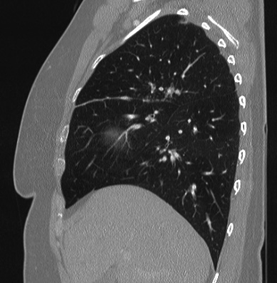 Cardiac sarcoidosis (Radiopaedia 74548-85534 Sagittal lung window 67).jpg
