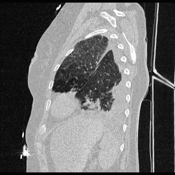Cardiogenic pulmonary edema (Radiopaedia 29213-29609 Sagittal lung window 78).jpg