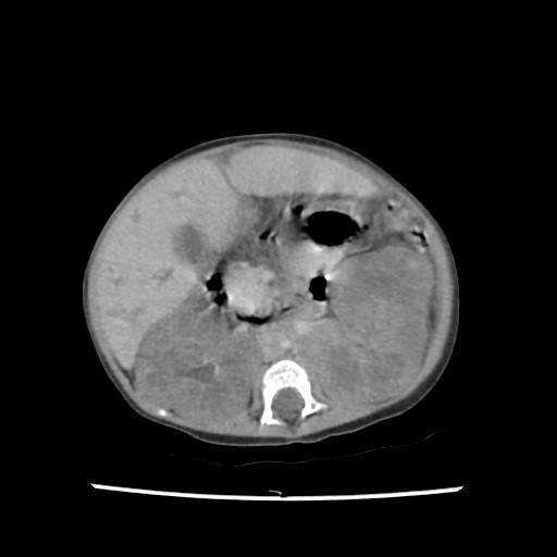 Caroli disease with autosomal recessive polycystic kidney disease (ARPKD) (Radiopaedia 89651-106703 B 102).jpg