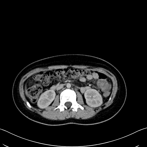 Caroli disease with medullary sponge kidney (Radiopaedia 82622-96804 C 33).jpg