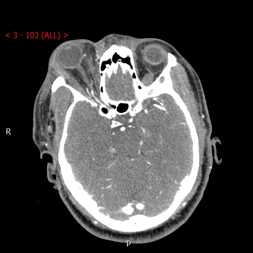 Caroticocavernous fistula (Radiopaedia 42346-45457 B 34).jpg