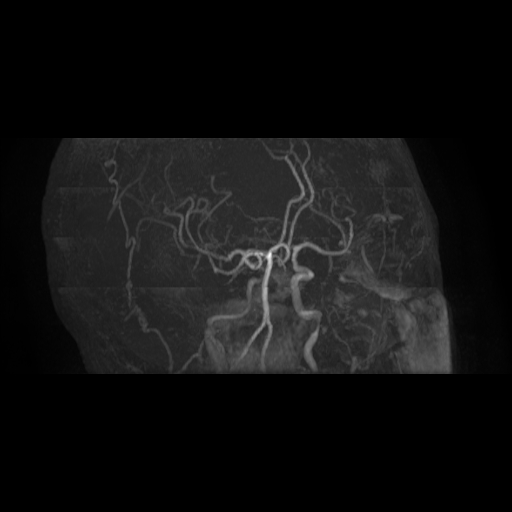 File:Carotid arterial dissection with acute cerebral infarction (Radiopaedia 26636-26784 MRA 14).jpg