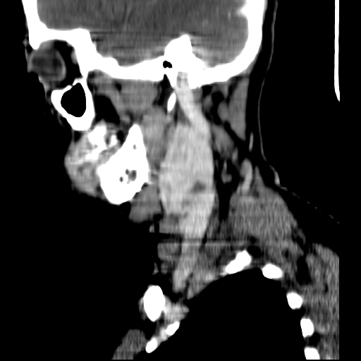 File:Carotid body tumor (Radiopaedia 27890-28124 C 20).jpg