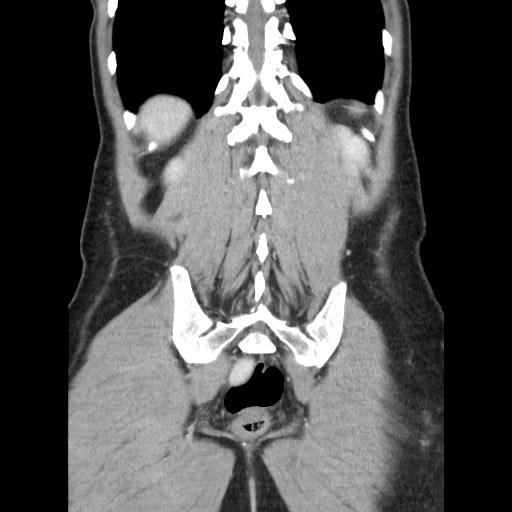 Castleman disease with fibrous pseudotumor in the abdomen (Radiopaedia 77296-89373 B 76).jpg