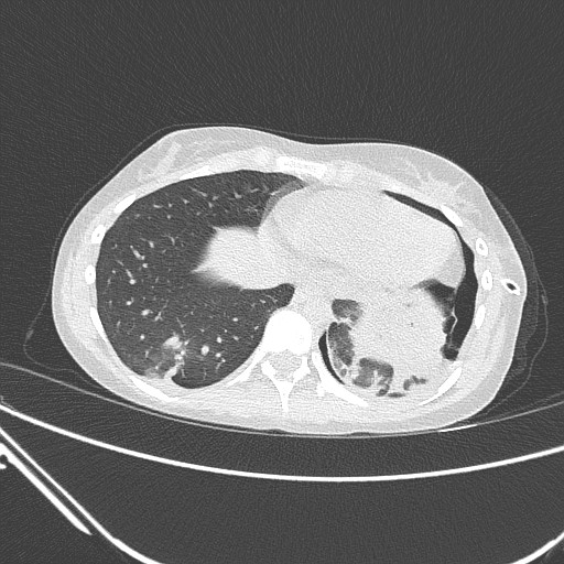 Catamenial pneumothorax (Radiopaedia 27946-28197 lung window 123).jpg
