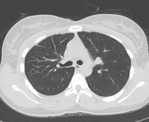 File:Catamenial pneumothorax (Radiopaedia 54382-60600 Axial 15).png