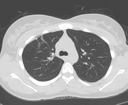 File:Catamenial pneumothorax (Radiopaedia 54382-60600 Axial 23).png