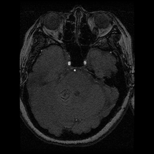 Cavernoma, DVA and right ICA aneurysm (Radiopaedia 33890-35072 E 69).png