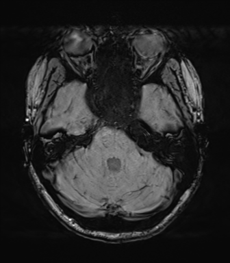 File:Cavernoma with bleed - midbrain (Radiopaedia 54546-60773 Axial SWI 15).png