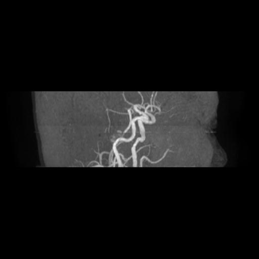Cavernoma with developmental venous anomaly (Radiopaedia 22470-22507 MRA 17).jpg