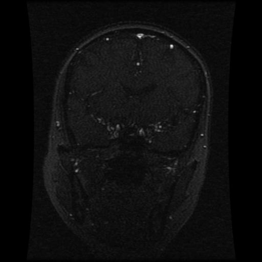 Cavernoma with developmental venous anomaly (Radiopaedia 22470-22507 MRV 86).jpg