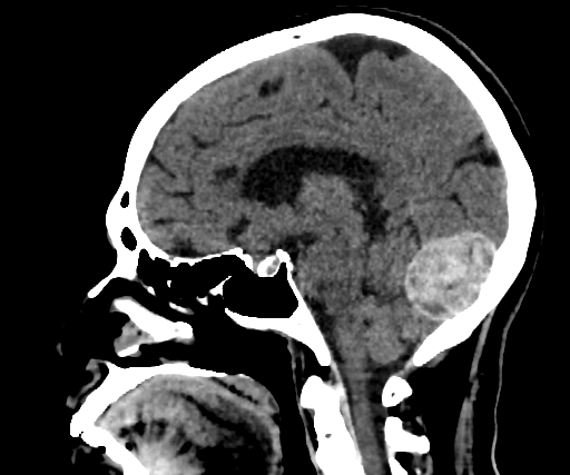 Cavernous hemangioma of the cerebellar falx (Radiopaedia 73025-83723 B 154).jpg