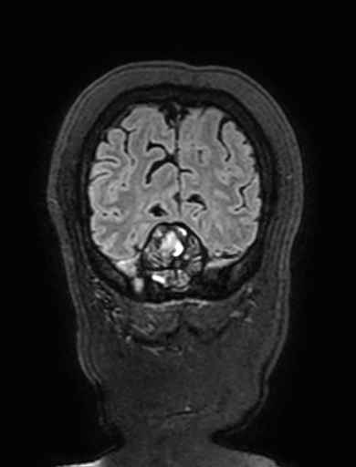 Cavernous hemangioma of the cerebellar falx (Radiopaedia 73025-83724 Coronal FLAIR 319).jpg