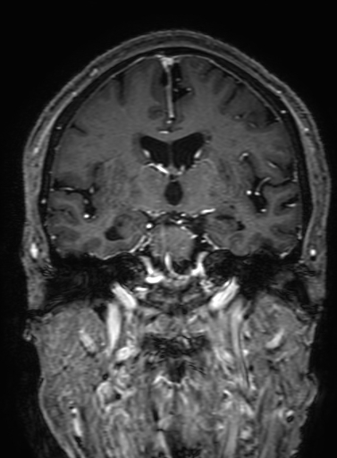 Cavernous hemangioma of the cerebellar falx (Radiopaedia 73025-83724 Coronal T1 C+ 185).jpg