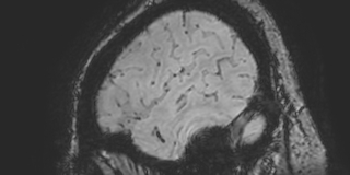 Cavernous hemangioma of the cerebellar falx (Radiopaedia 73025-83724 Sagittal BOLD 179).jpg