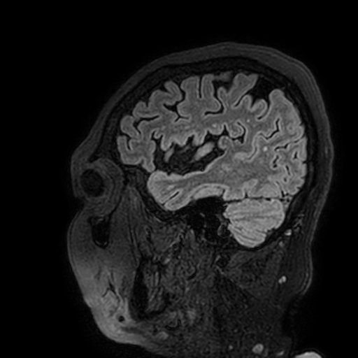 Cavernous hemangioma of the cerebellar falx (Radiopaedia 73025-83724 Sagittal FLAIR 178).jpg