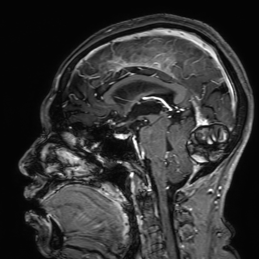 File:Cavernous hemangioma of the cerebellar falx (Radiopaedia 73025-83724 Sagittal T1 C+ 109).jpg