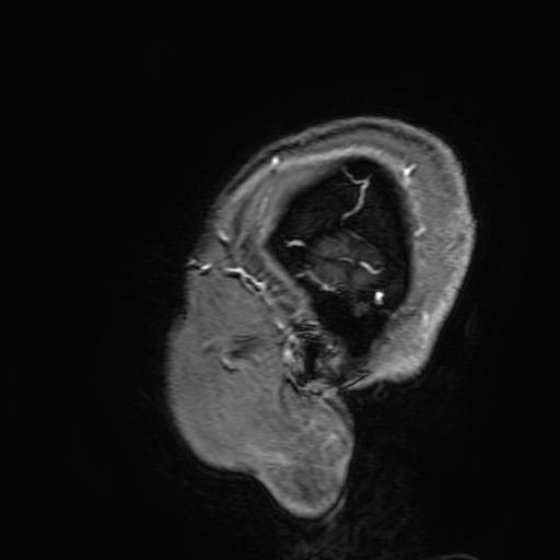 File:Cavernous hemangioma of the cerebellar falx (Radiopaedia 73025-83724 Sagittal T1 C+ 201).jpg