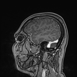 Cavernous sinus meningioma (Radiopaedia 63682-72367 Sagittal T1 C+ 47).jpg