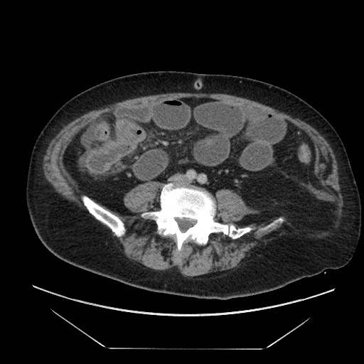 Cecal adenocarcinoma (Radiopaedia 64871-73817 A 61).jpg