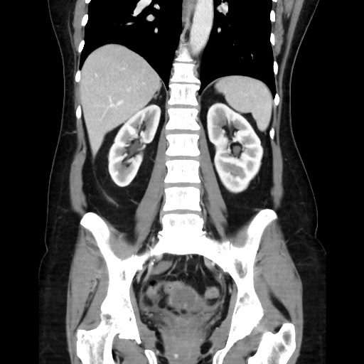 Cecal adenocarcinoma (Radiopaedia 75909-87331 B 33).jpg