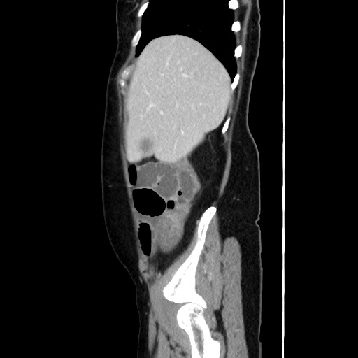 Cecal adenocarcinoma (Radiopaedia 75909-87331 C 18).jpg