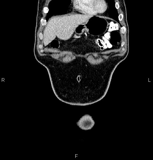 Cecal adenocarcinoma (Radiopaedia 85324-100916 D 6).jpg