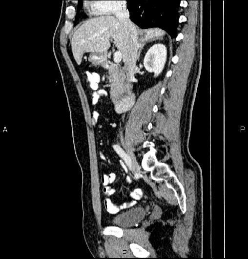 Cecal adenocarcinoma (Radiopaedia 85324-100916 E 37).jpg