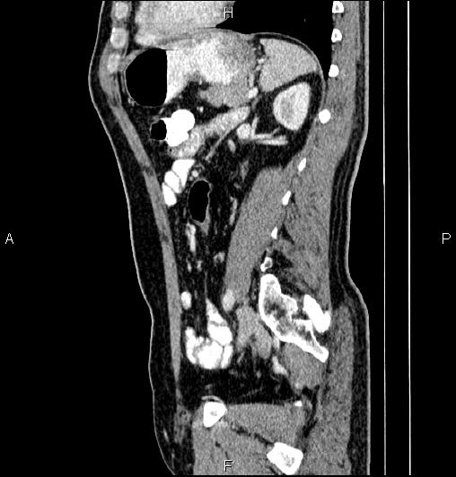 Cecal adenocarcinoma (Radiopaedia 85324-100916 E 60).jpg