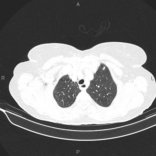 Cecal cancer (Radiopaedia 85610-101358 Axial lung window 13).jpg