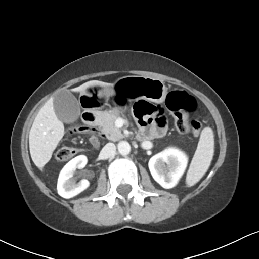 Cecal internal hernia through the foramen of Winslow (Radiopaedia 44820-48651 B 30).png