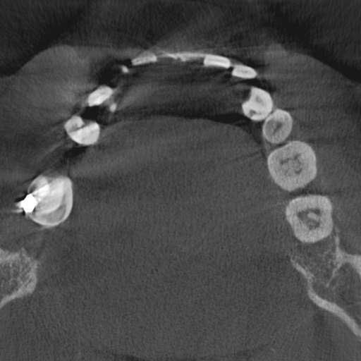 Cemento-osseous dysplasia (Radiopaedia 48251-53126 Axial non-contrast 63).jpg