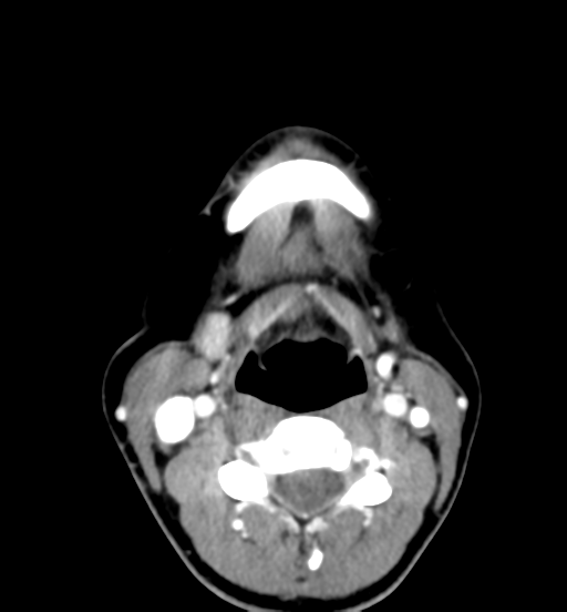 File:Cemento-ossifying fibroma (Radiopaedia 46243-50643 Axial C+ delayed 48).png