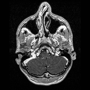 Central-variant posterior reversible encephalopathy syndrome (PRES) (Radiopaedia 43880-47358 Axial T1 C+ 17).jpg