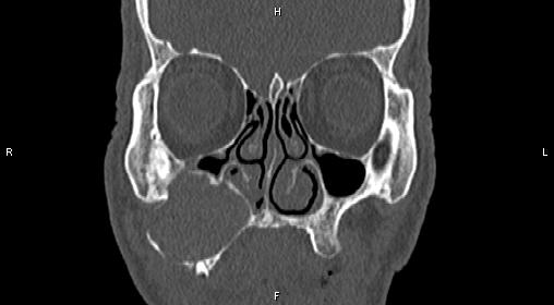 File:Central giant cell granuloma (Radiopaedia 83346-97761 Coronal bone window 11).jpg