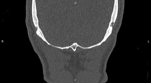 File:Central giant cell granuloma (Radiopaedia 83346-97761 Coronal bone window 49).jpg