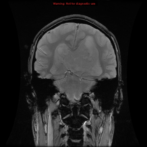 File:Central neurocytoma (Radiopaedia 13188-13206 G 5).jpg