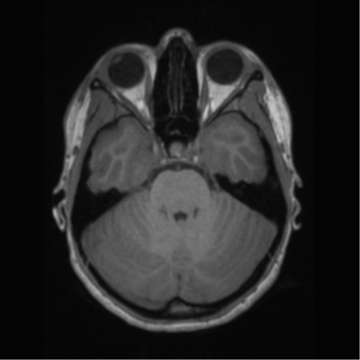 File:Central neurocytoma (Radiopaedia 37664-39557 Axial T1 21).png